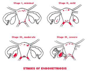 xstages-of-endometriosis